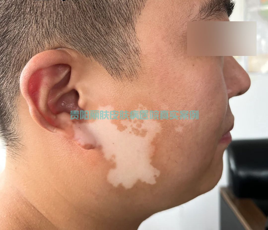 白癜风案例