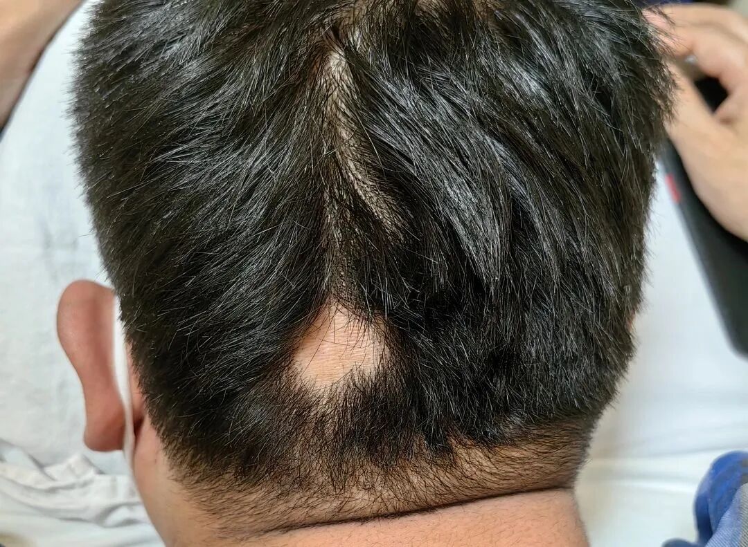 斑秃不仅仅只是头发的问题，这些并发症也要警惕！