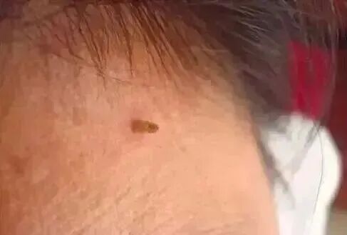 南方地区的小伙伴皮肤上长出的“小肉粒”是个啥，能揪掉吗？